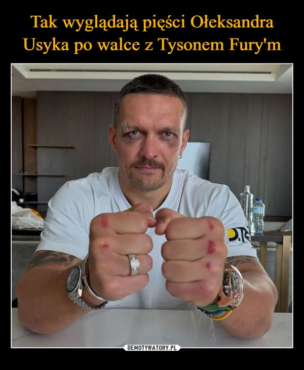 
    Tak wyglądają pięści Ołeksandra Usyka po walce z Tysonem Fury'm