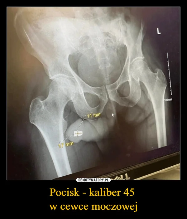 
    Pocisk - kaliber 45 w cewce moczowej