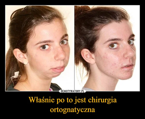 
    Właśnie po to jest chirurgia ortognatyczna