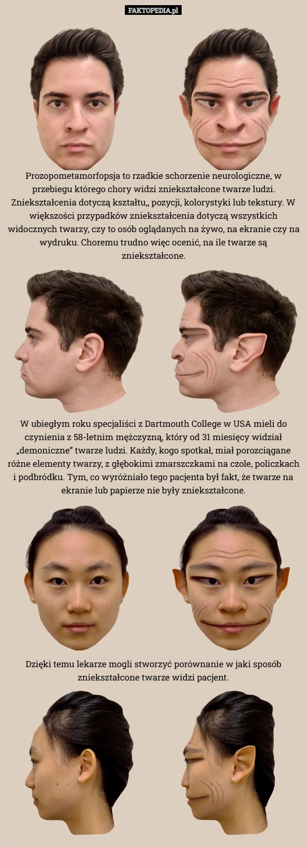 
    Prozopometamorfopsja to rzadkie schorzenie neurologiczne, w przebiegu którego