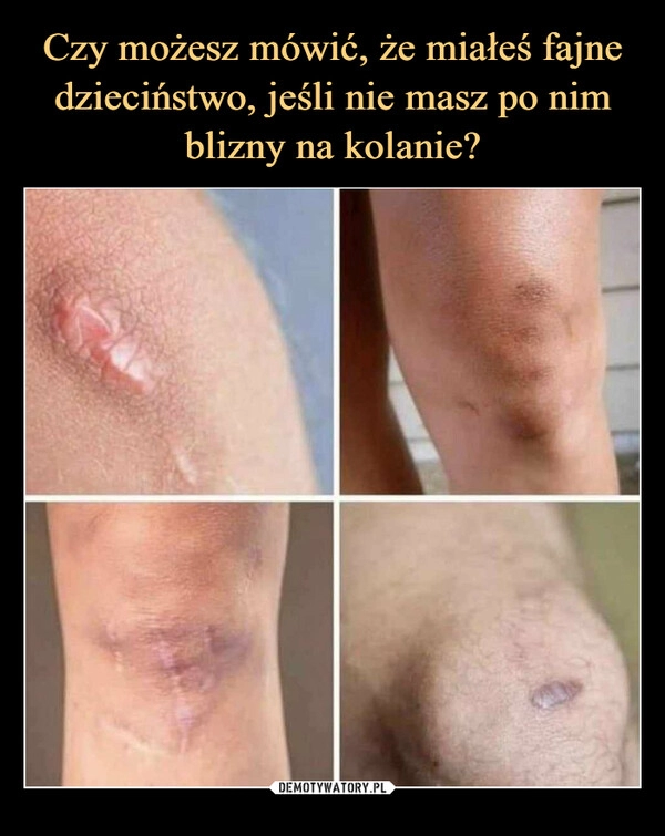 
    Czy możesz mówić, że miałeś fajne dzieciństwo, jeśli nie masz po nim blizny na kolanie?