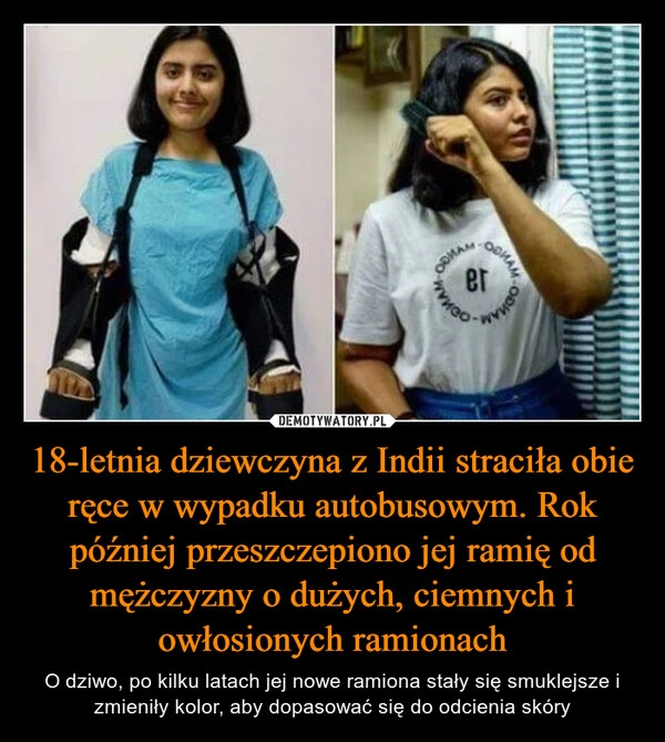 
    
18-letnia dziewczyna z Indii straciła obie ręce w wypadku autobusowym. Rok później przeszczepiono jej ramię od mężczyzny o dużych, ciemnych i owłosionych ramionach 