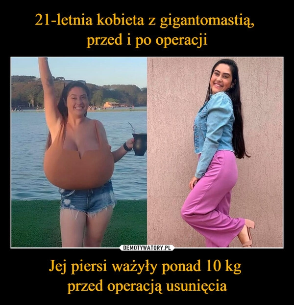 
    21-letnia kobieta z gigantomastią, 
przed i po operacji Jej piersi ważyły ponad 10 kg 
przed operacją usunięcia