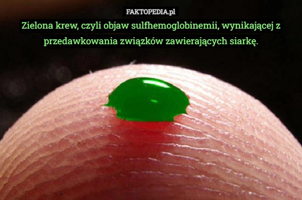 
    
			Zielona krew, czyli objaw sulfhemoglobinemii, wynikającej z przedawkowania					