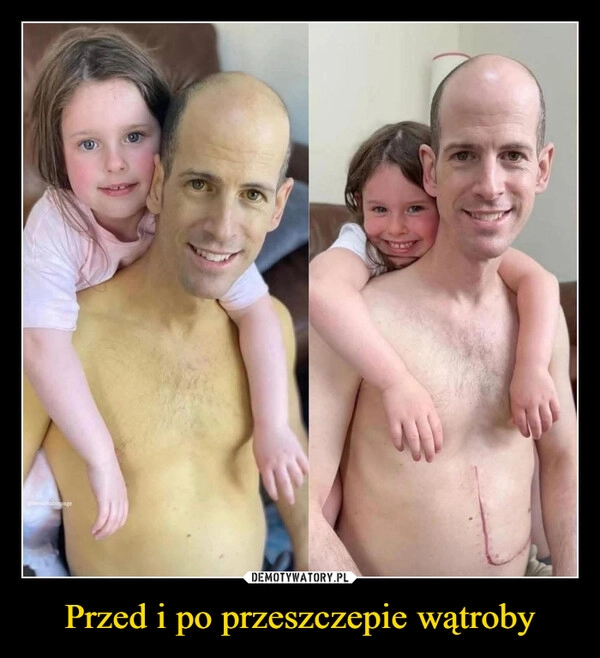 
    Przed i po przeszczepie wątroby