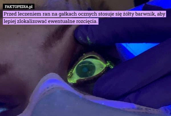 
    Przed leczeniem ran na gałkach ocznych stosuje się żółty barwnik, aby lepiej