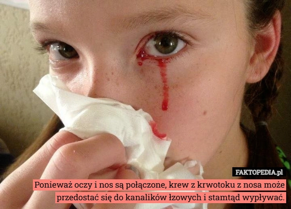
    Ponieważ oczy i nos są połączone, krew z krwotoku z nosa może przedostać