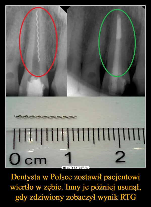 
    Dentysta w Polsce zostawił pacjentowi wiertło w zębie. Inny je później usunął, gdy zdziwiony zobaczył wynik RTG