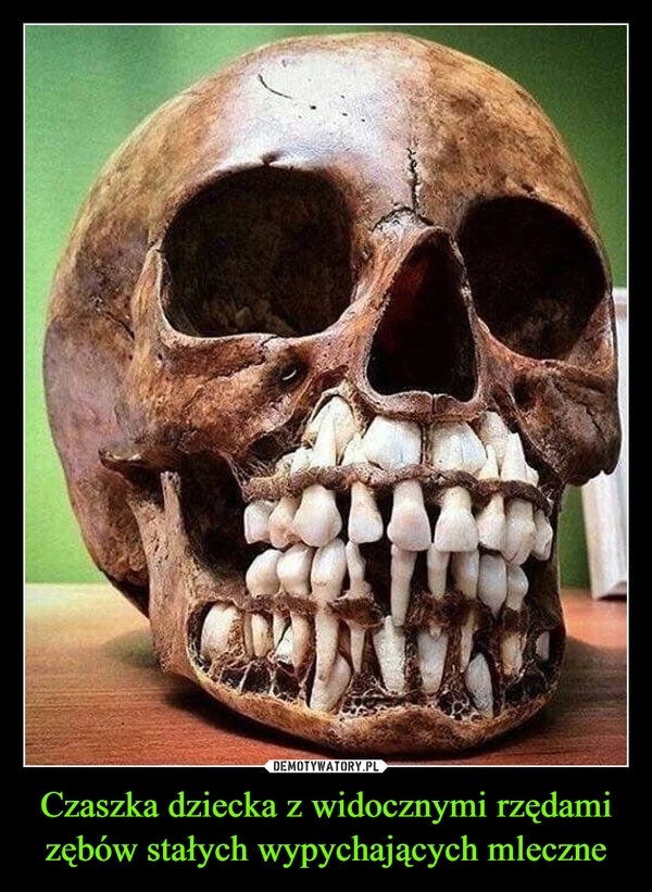 
    Czaszka dziecka z widocznymi rzędami zębów stałych wypychających mleczne