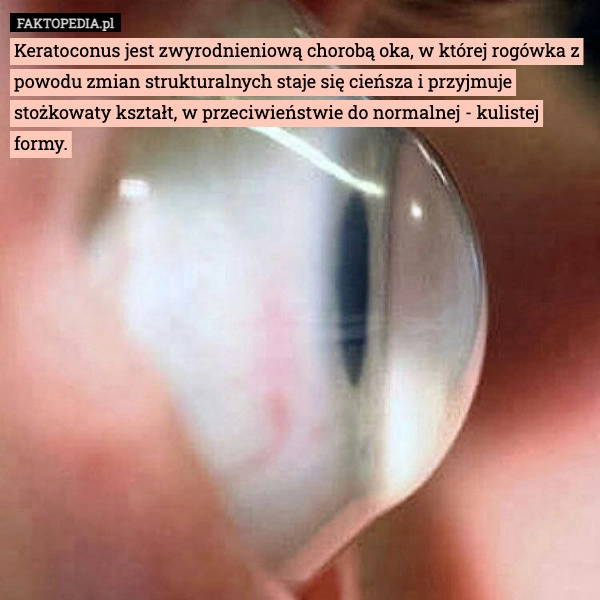 
    Keratoconus jest zwyrodnieniową chorobą oka, w której rogówka z powodu zmian