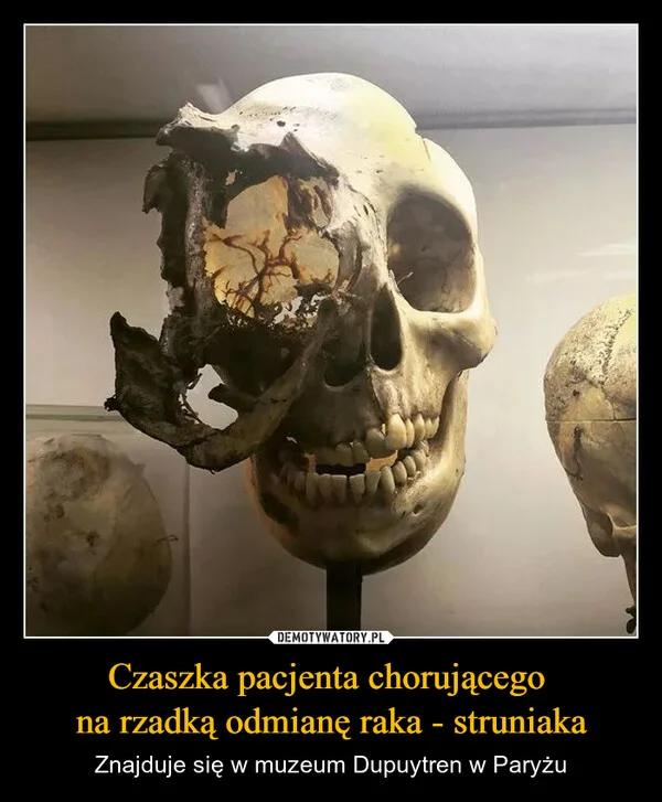 
    Czaszka pacjenta chorującego na rzadką odmianę raka - struniaka