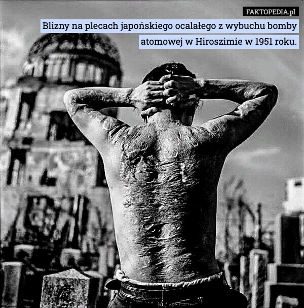 
    Blizny na plecach japońskiego ocalałego z wybuchu bomby atomowej w Hiroszimie
