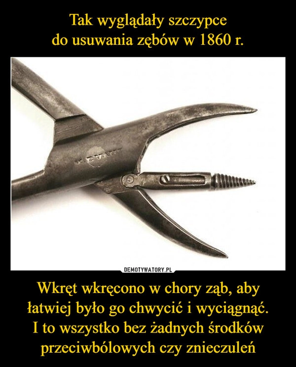 
    Tak wyglądały szczypce
do usuwania zębów w 1860 r. Wkręt wkręcono w chory ząb, aby łatwiej było go chwycić i wyciągnąć.
I to wszystko bez żadnych środków przeciwbólowych czy znieczuleń