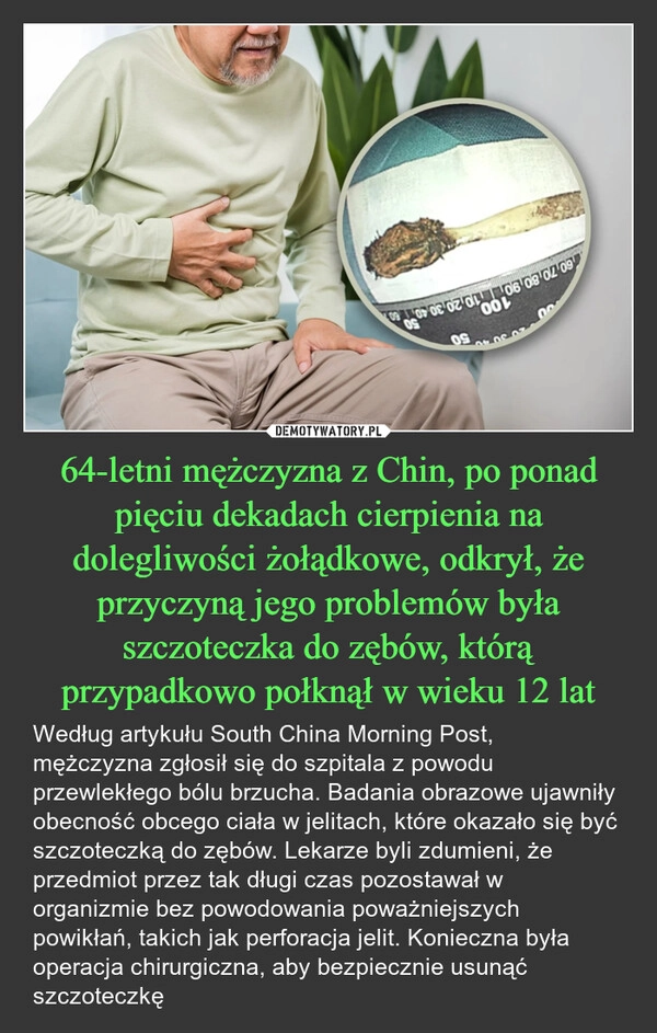 
    64-letni mężczyzna z Chin, po ponad pięciu dekadach cierpienia na dolegliwości żołądkowe, odkrył, że przyczyną jego problemów była szczoteczka do zębów, którą przypadkowo połknął w wieku 12 lat
