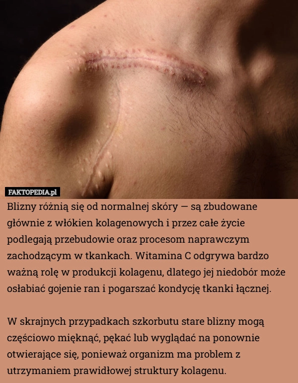 
    Blizny różnią się od normalnej skóry — są zbudowane głównie z włókien kolagenowych