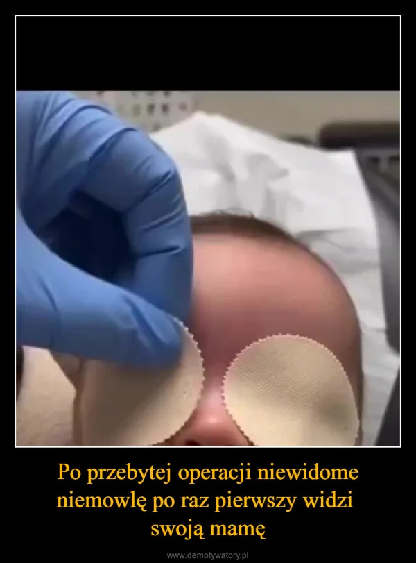 
    Po przebytej operacji niewidome niemowlę po raz pierwszy widzi swoją mamę