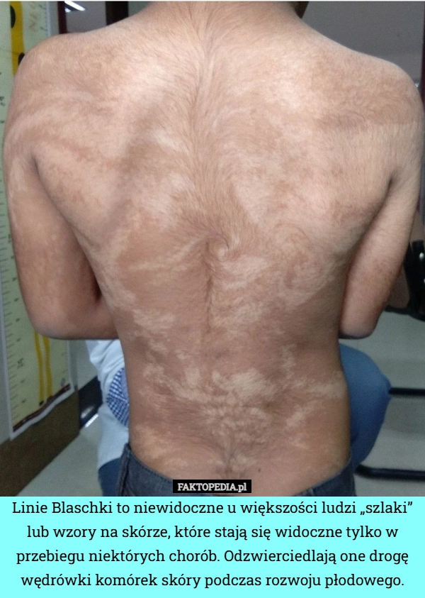 
    Linie Blaschki to niewidoczne u większości ludzi „szlaki” lub wzory na skórze,