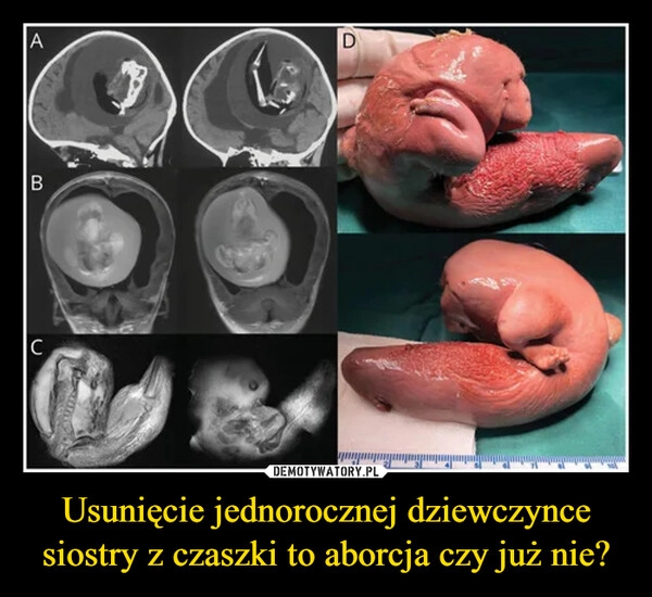 
    Usunięcie jednorocznej dziewczynce siostry z czaszki to aborcja czy już nie?