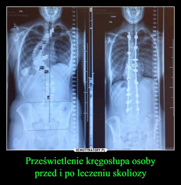 
    Prześwietlenie kręgosłupa osoby przed i po leczeniu skoliozy