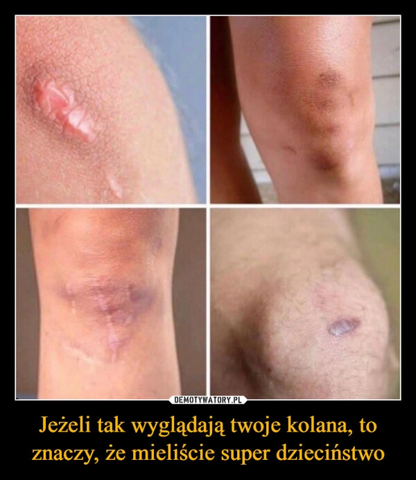 
    Jeżeli tak wyglądają twoje kolana, to znaczy, że mieliście super dzieciństwo