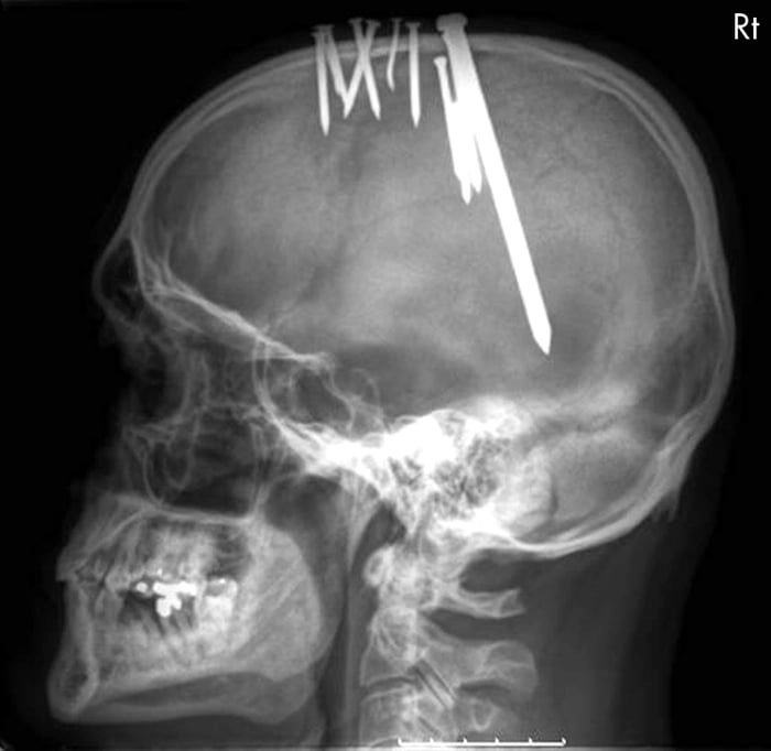 
    Man with headaches used nails to try to relieve the pain over course of a year before seeking medical attention. He survived with no ill effects.