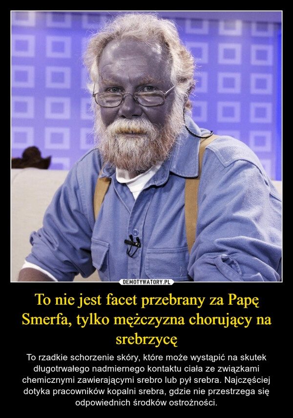 
    To nie jest facet przebrany za Papę Smerfa, tylko mężczyzna chorujący na srebrzycę