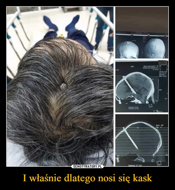 
    I właśnie dlatego nosi się kask