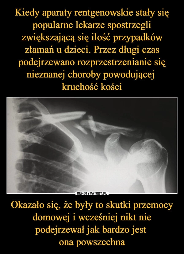 
    
Kiedy aparaty rentgenowskie stały się popularne lekarze spostrzegli zwiększającą się ilość przypadków złamań u dzieci. Przez długi czas podejrzewano rozprzestrzenianie się nieznanej choroby powodującej
kruchość kości Okazało się, że były to skutki przemocy domowej i wcześniej nikt nie podejrzewał jak bardzo jest
ona powszechna 