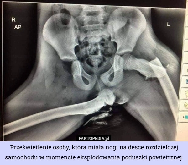 
    Prześwietlenie osoby, która miała nogi na desce rozdzielczej samochodu w...