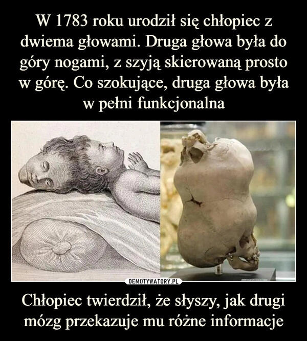 
    W 1783 roku urodził się chłopiec z dwiema głowami. Druga głowa była do góry nogami, z szyją skierowaną prosto w górę. Co szokujące, druga głowa była w pełni funkcjonalna Chłopiec twierdził, że słyszy, jak drugi mózg przekazuje mu różne informacje