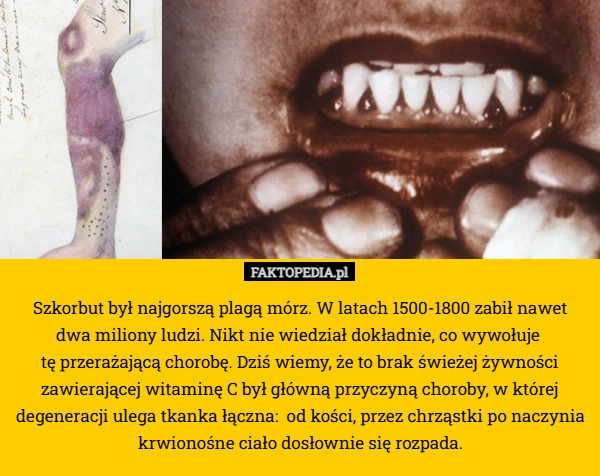 
    Szkorbut był najgorszą plagą mórz. W latach 1500-1800 zabił nawet
 dwa miliony