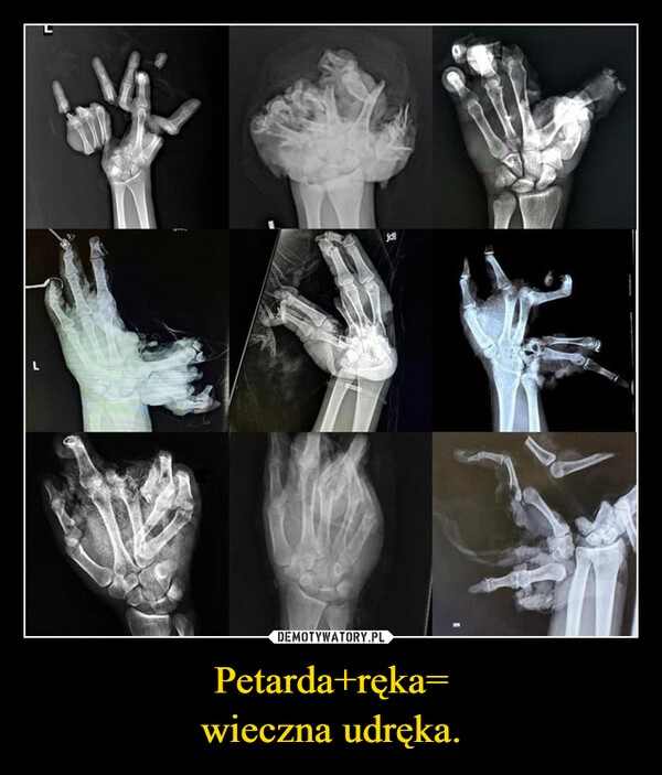 
    Petarda+ręka=
wieczna udręka.