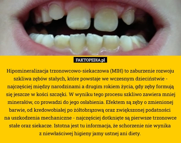 
    Hipomineralizacja trzonowcowo-siekaczowa (MIH) to zaburzenie rozwoju szkliwa