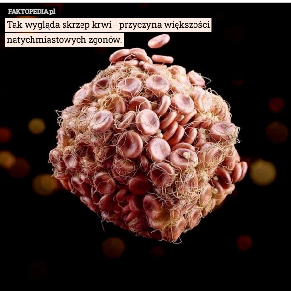 
    Tak wygląda skrzep krwi - przyczyna większości natychmiastowych zgonów.