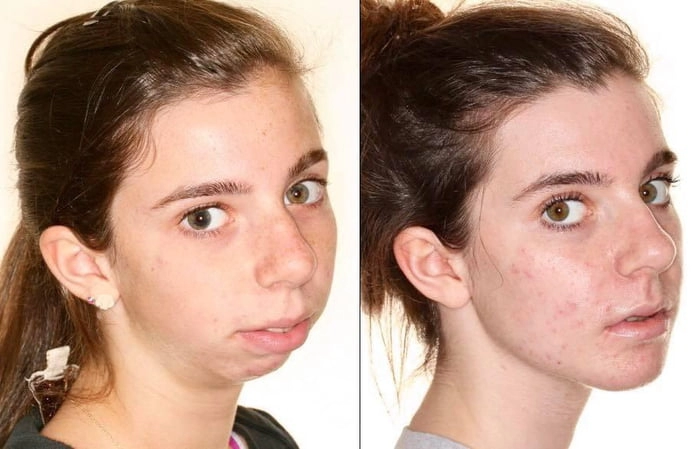 
    What orthognathic surgery can do