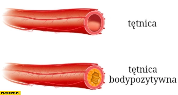 
    Tętnica vs tętnica bodypozytywna zapchana porównanie