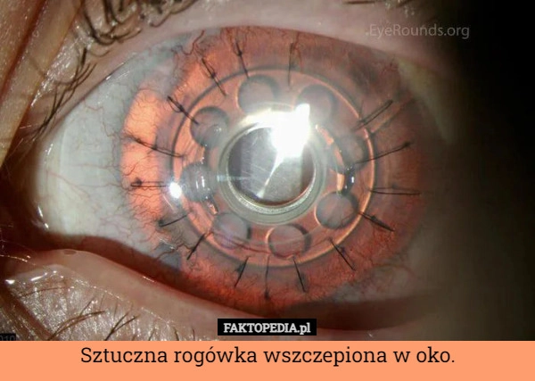 
    Sztuczna rogówka wszczepiona w oko.