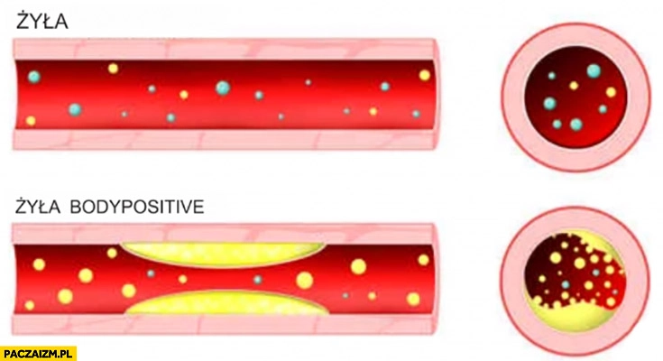 
    Żyła vs żyła body positive jak wygląda miażdżyca porównanie