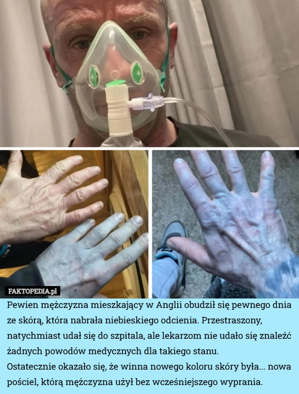 
    Pewien mężczyzna mieszkający w Anglii obudził się pewnego dnia ze skórą,