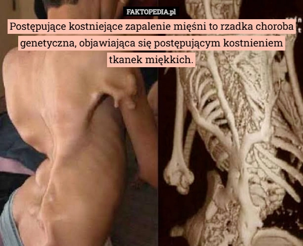 
    Postępujące kostniejące zapalenie mięśni to rzadka choroba genetyczna, objawiająca