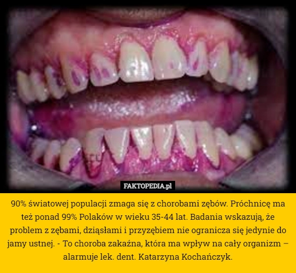 
    90% światowej populacji zmaga się z chorobami zębów. Próchnicę ma też ponad