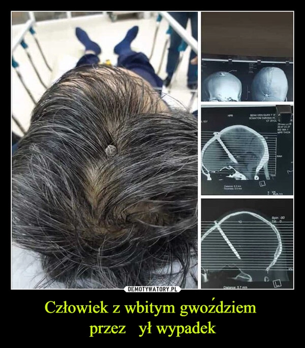 
    Człowiek z wbitym gwoździem 
przeżył wypadek