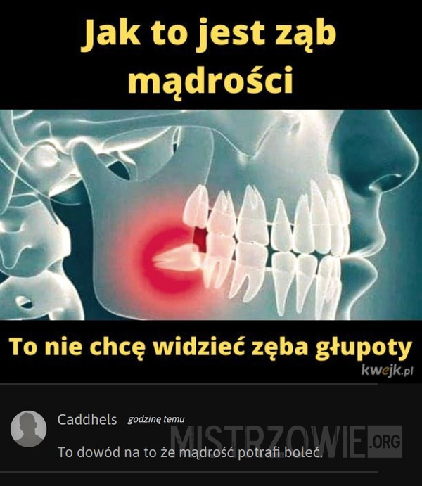 
    Ząb mądrości