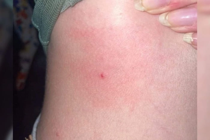 
    145 people (mostly white french girls) were pricked with needles with unknown substance in France during a nationwide music festival over the weekend.