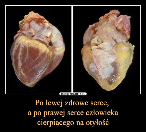 
    Po lewej zdrowe serce, a po prawej serce człowieka cierpiącego na otyłość