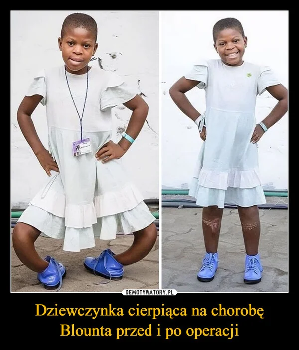 
    Dziewczynka cierpiąca na chorobę Blounta przed i po operacji