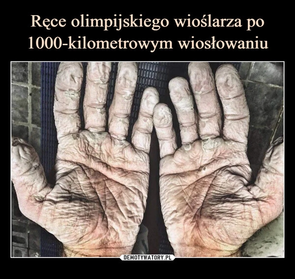 
    
Ręce olimpijskiego wioślarza po 1000-kilometrowym wiosłowaniu 