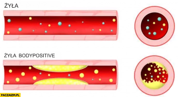 
    Żyła vs żyła body positive jak wygląda miażdżyca porównanie