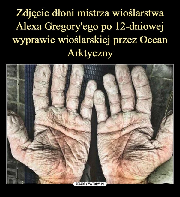 
    Zdjęcie dłoni mistrza wioślarstwa Alexa Gregory'ego po 12-dniowej wyprawie wioślarskiej przez Ocean Arktyczny