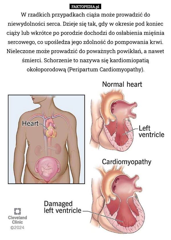 
    W rzadkich przypadkach ciąża może prowadzić do niewydolności serca. Dzieje...